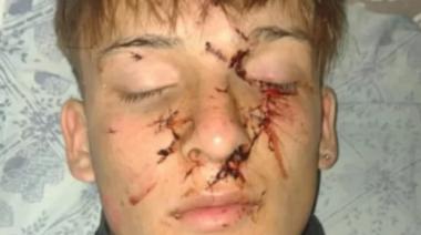 Violenta agresión en un bar de Claromecó a un joven necochense: piden justicia por Axel Sandoval