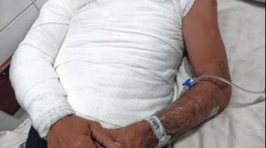 Pelea entre hermanos en Santa Fe termina con uno de ellos quemado por una insólita discusión