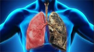 Día Mundial del EPOC: una enfermedad silenciosa con alto impacto en la salud