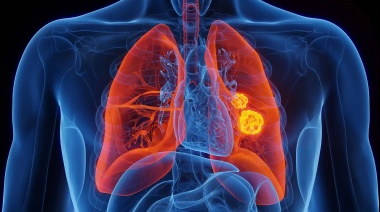 El Impacto Económico del Cáncer de Pulmón en Argentina 